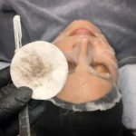 Can Dermaplaning Permanently Remove Facial Hair