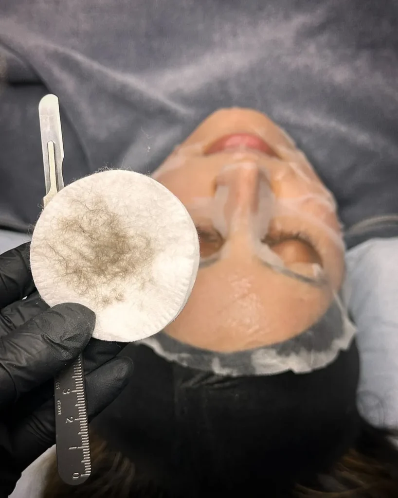 Can Dermaplaning Permanently Remove Facial Hair