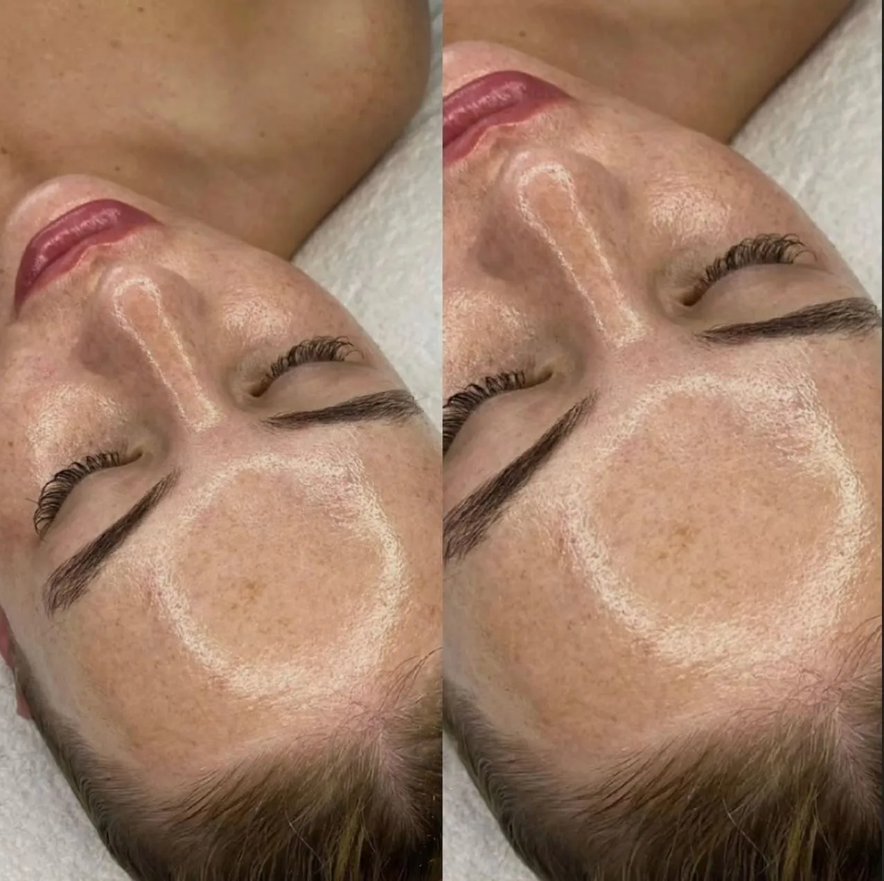 Steamboat Aviator | Can Dermaplaning Permanently Remove Facial Hair? What Regrowth Feels Like
