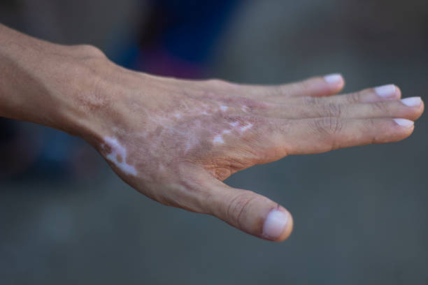 Human hand with vitiligo condition