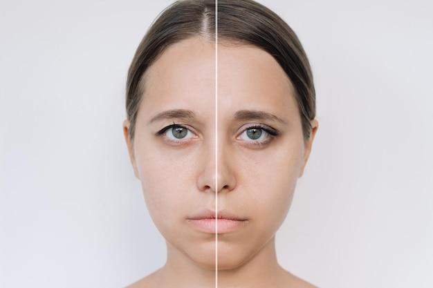 Before and after beauty treatment comparison of a woman's face