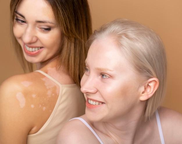 Two women smiling, one with vitiligo, promoting skin positivity and friendship