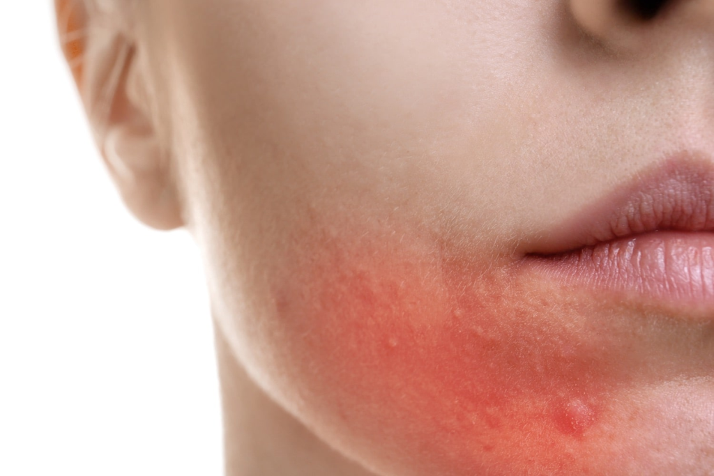 Man applying soothing aftershave balm to reduce beard rash after kissing