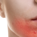 Man applying soothing aftershave balm to reduce beard rash after kissing