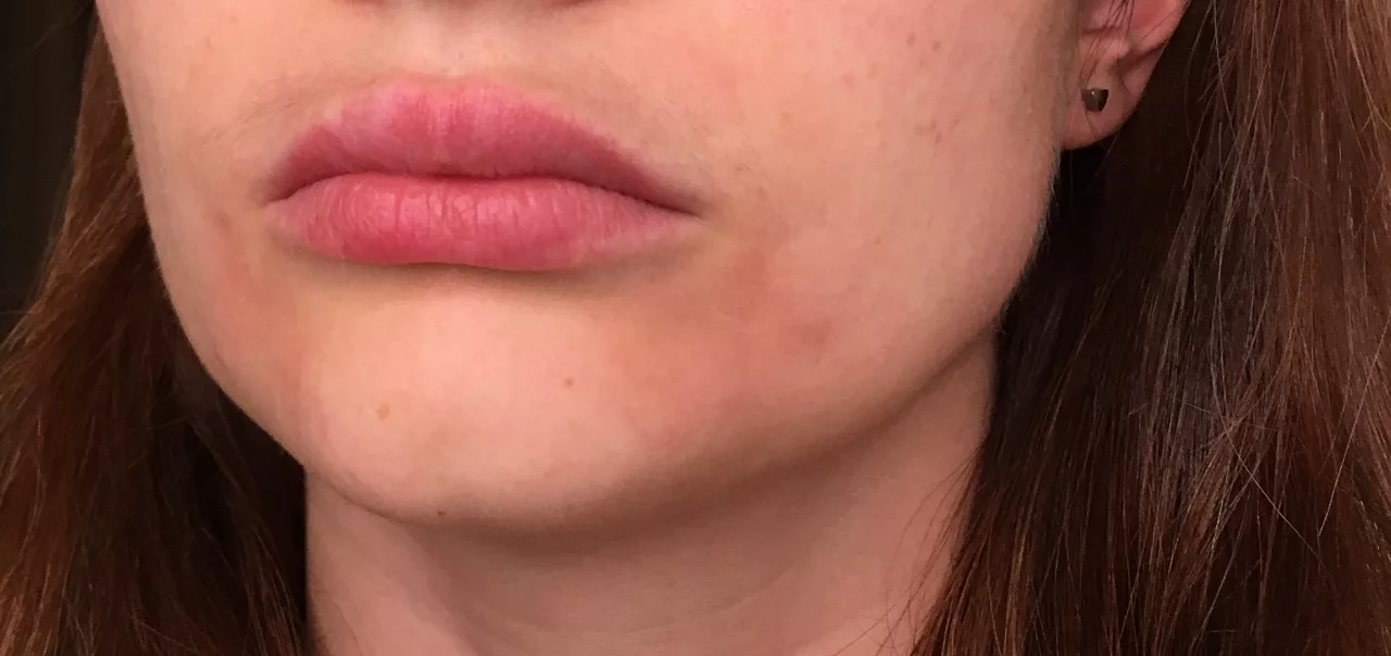 Close-up of irritated skin due to beard rash from kissing, with treatment products